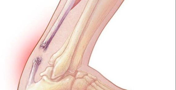 Bị đứt gân chân bao lâu thì lành? Cách hỗ trợ điều trị hiệu quả.